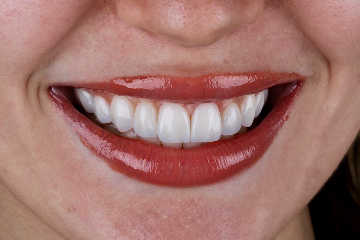 Sorriso natural com estética premium
